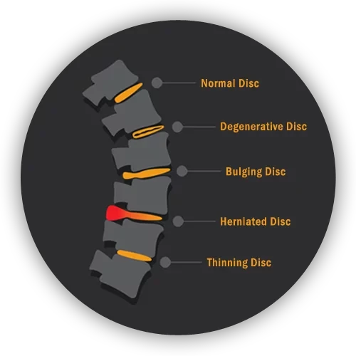 A graphic showing the difference between a healthy disc and various stages of degeneration